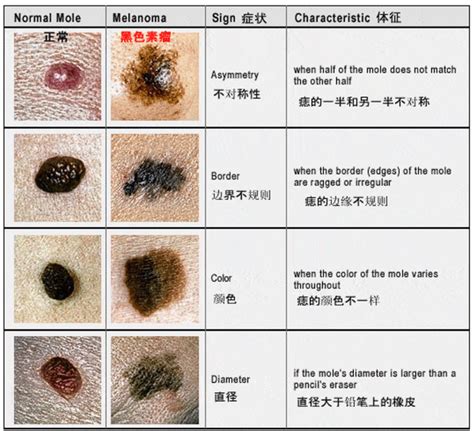 身上的痣|有这5种“痣”要小心，可能会恶变